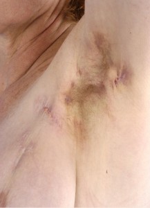 Hidradenitis suppurativa of the axillae after treatment with infliximab