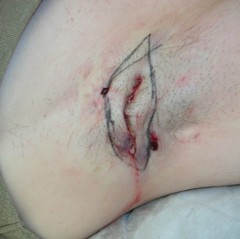 Armpit fistula in hidradenitis suppurativa