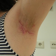 Armpit fistula in hidradenitis suppurativa