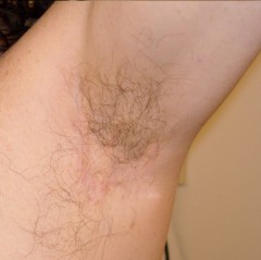 Armpit fistula in hidradenitis suppurativa