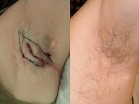 Hidradenitis suppurativa before and after excision