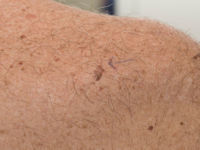 Hidroacanthoma simplex