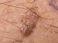 Hidroacanthoma simplex