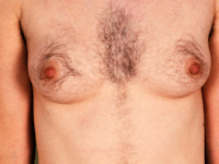 Hirsutism (excessive hair growth in women, in a male pattern) (click on photo to enlarge) [source: internet]