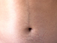 Hirsutism (excessive hair growth in women, in a male pattern) (click on photo to enlarge) [source: internet]