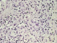 Histoplasmose, histologie