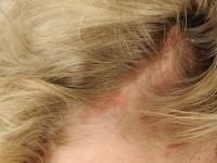 Hoofdroos (pityriasis capitis)