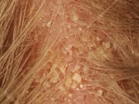 Dandruff (pityriasis capitis)