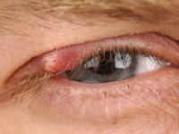 Hordeolum externum