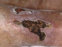 Huidinfarct bij&nbsp; diabetes