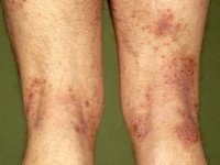 Job syndroom, hyper IgE syndroom