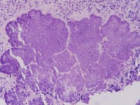 Job syndroom, hyper IgE syndroom