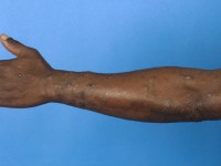 Hypereosinofiel syndroom