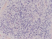 Hypereosinofiel syndroom