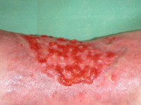 Hypergranulatie weefsel