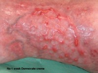 Hypergranulatie weefsel