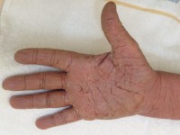 Palmoplantaire hyperkeratose, paraneoplastisch