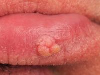 Hyperkeratotisch papilloom