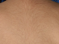 Congenitale hypertrichosis