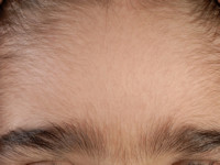 Congenitale hypertrichosis