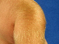 Hypertrichose door ciclosporine