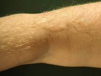 Hypertrichose door corticosteroïden