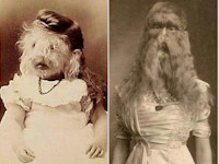 hypertrichosis lanuginosa congenita