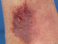 Hypodermitis (acute lipodermatosclerose)