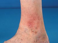 Hypodermitis (acute lipodermatosclerose)