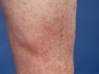 Hypodermitis (acute lipodermatosclerose)