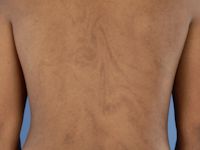 Hypomelanosis van Ito