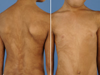 hypomelanosis van Ito