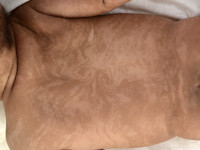 hypomelanosis van Ito