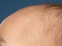 Hypotrichosis simplex of the scalp