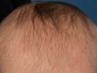 Hypotrichosis simplex of the scalp