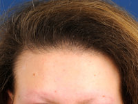 Marie Unna type congenitale hypotrichosis