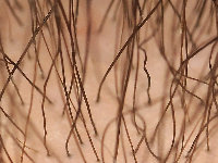 Marie Unna type congenitale hypotrichosis