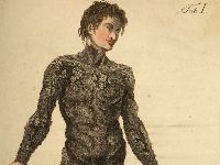 Ichthyosis hystrix type Lambert