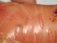 Lamellaire ichthyosis