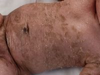 Lamellaire ichthyosis