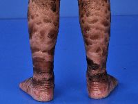 Lamellaire ichthyosis