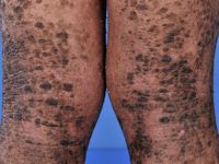 Lamellaire ichthyosis