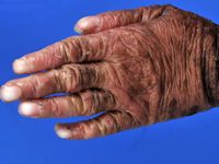 Lamellaire ichthyosis