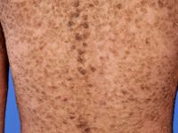 Lamellaire ichthyosis