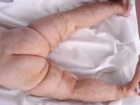 Ichthyosis mosaïcisme