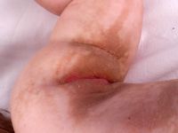 Ichthyosis mosaïcisme