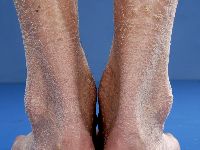 Ichthyosis vulgaris