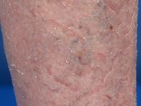Ichthyosis vulgaris