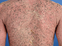 Ichtyosiforme erytrodermie bij CARD14 mutatie