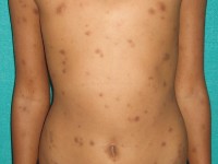 Idiopathische eruptieve maculaire pigmentatie